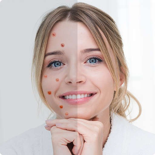 Remove Acne from Face TDx_YEIzDZF-_UlPL35fgessYnkeZYl91xipMGNF32trgQqWWGyBX2KjPUTzSqRvo28
