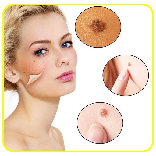 Skin Moles, Remédies to Remove fiMi3DA9RJbQVqfdv-3IF5cgNtTax56yiolZSi9bPn3XQOUVRApSYOKtCHoZXZGa60_5