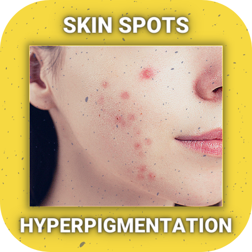 Hyperpigmentation: Skin Spots TGD5Y5iEfVD_vdFMrnvUaBwR8_YcXCC-DRM4UUPwGPPT4alsA8-RJ_H6aAW_c94CwiI